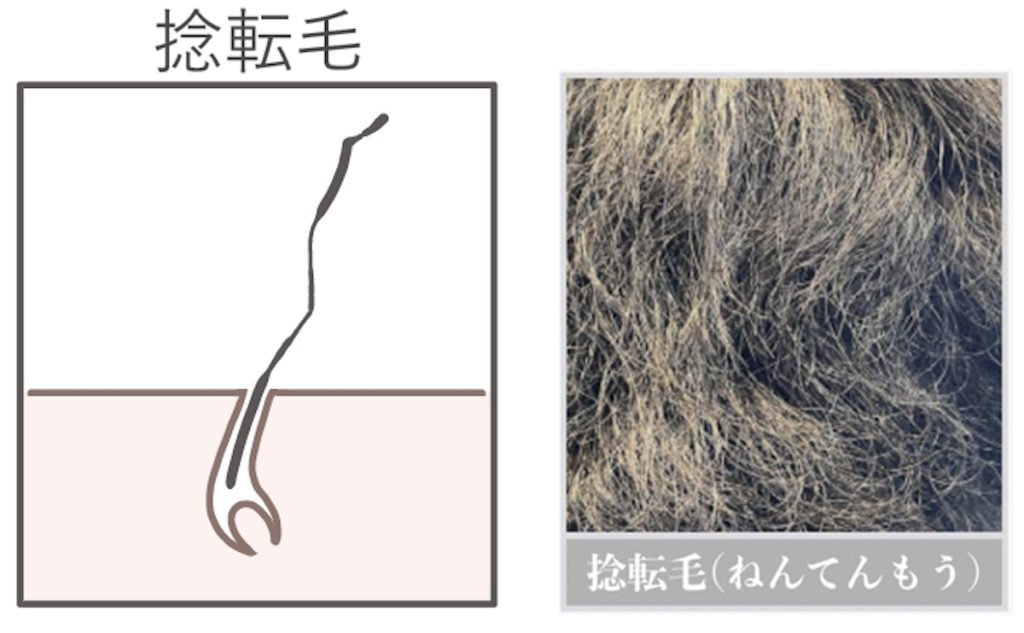 捻転毛